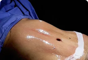 abdominoplastia en Medellín