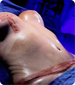 Cirugía de abdominoplastia en Medellín