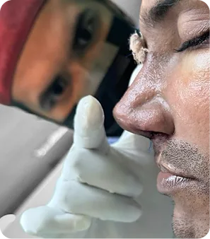 Rinoplastia en Colombia para armonía facial