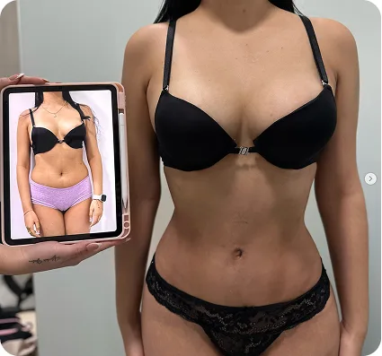 plan de Mommy Makeover en Colombia para abdomen busto y contorno corporal