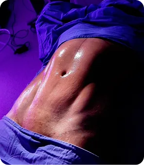 lipoescultura en Colombia y Medellin con tecnologia avanzada