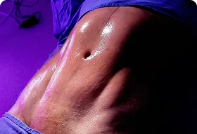 lipoescultura y marcación en Medellín
