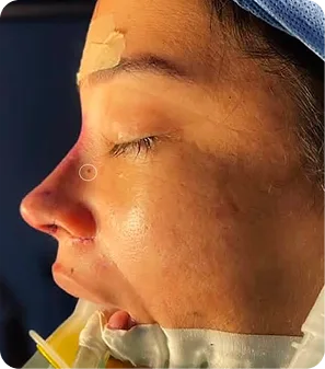 Cirugía de rinoplastia en Medellín Colombia