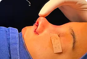 Rinoplastia en Medellín con el Dr. Alexander Luján