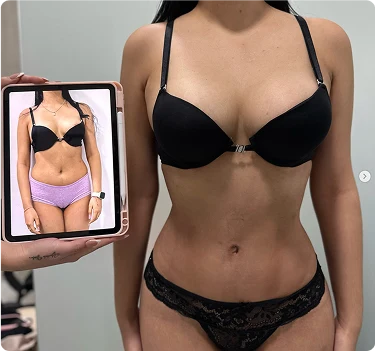 Comparación médica de resultado de lipoescultura abdominal