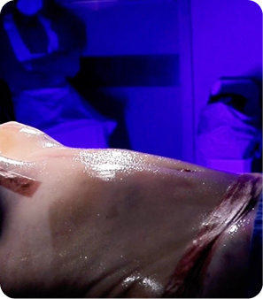 Abdominoplastia en colombia