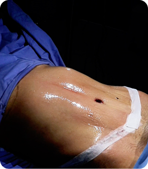 Abdominoplastia en medellin