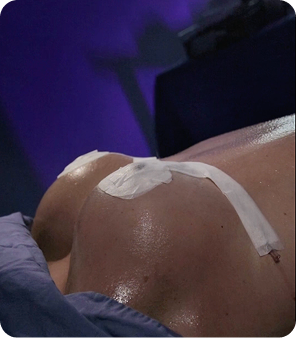 mastopexia dr alexander lujan