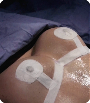 mastopexia en medellin